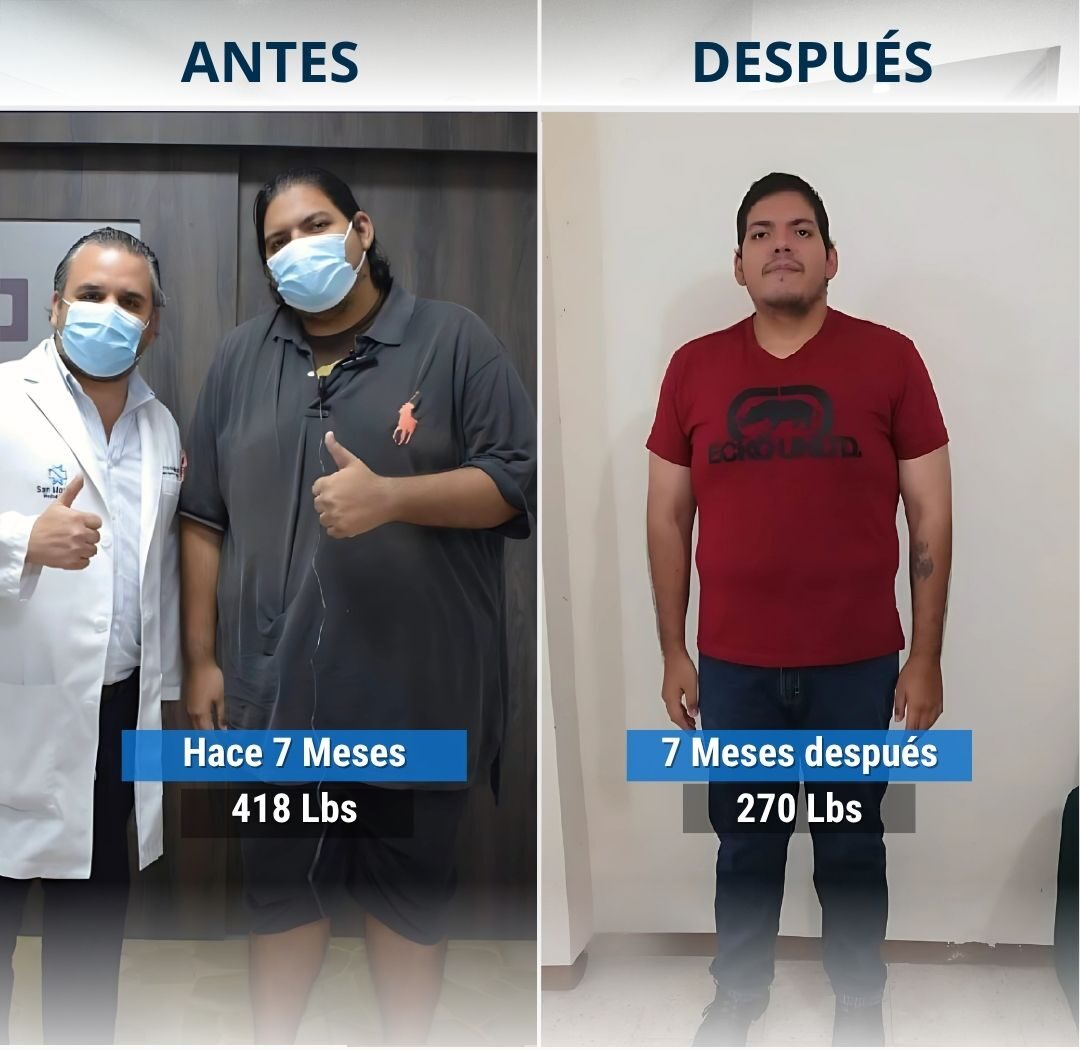 Andrés en 7 Meses ha perdido más de 148 libras, después de su Manga Gástrica mi equipo Bariátrico y yo lo hemos seguido acompañando en su Proceso.